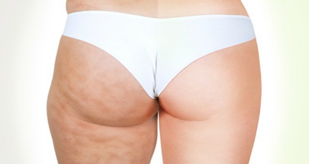 You Ban Be Cellulite Free 