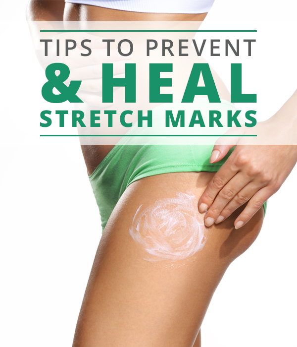 Tips to Prevent and Heal Stretch Marks