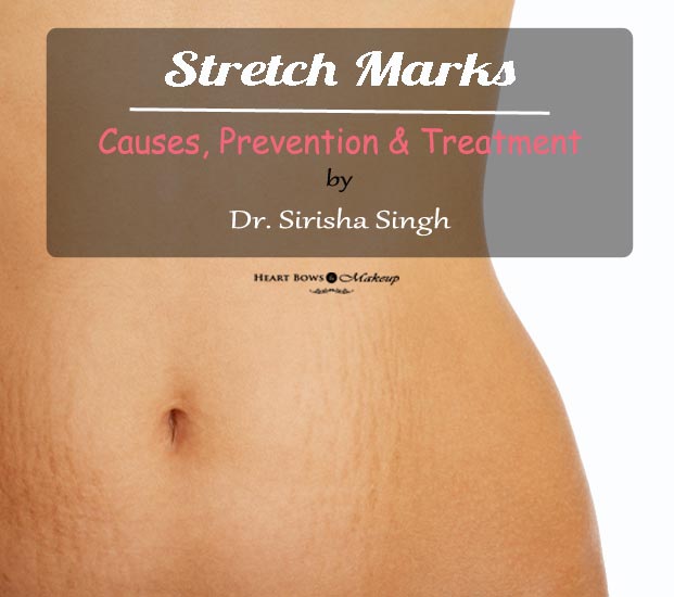 Causes-of-Stretch-Marks-Prevention-Cure-Treatment