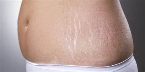 Everything you need to know about stretch marks – prevention, causes, myths, and effective elimination methods 
