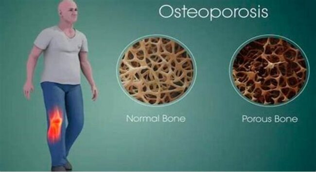 Understanding Osteoporosis – The Importance of Diagnosis, Prevention, and Diet 